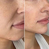 Smile Line Filler