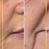 Smile Line Filler