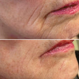 Marionette Line Filler