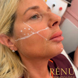 Cheek Filler
