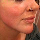 Jowl Smoothing Filler with Cannual Technique