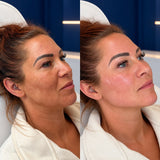 Jawline Filler in Lymington – Advanced Cannula Technique