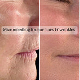 Mixsoon Microneedling in Lymington