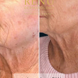 Microneedling with Salmon DNA in Lymington