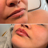 1.1ml Lip Filler in Lymington – Natural Lip Enhancement