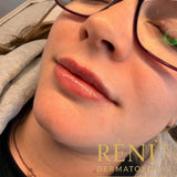 0.5ml Lip Filler – Natural Lip Enhancement