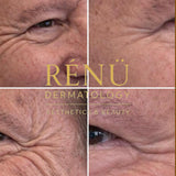 Anti Wrinkle 1 area