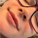 0.5ml Lip Filler – Natural Lip Enhancement