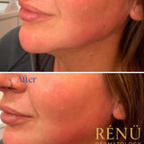 Jowl Smoothing Filler with Cannual Technique