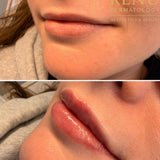 0.5ml Lip Filler – Natural Lip Enhancement