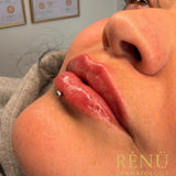 1.1ml Lip Filler in Lymington – Natural Lip Enhancement