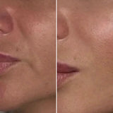Smile Line Filler